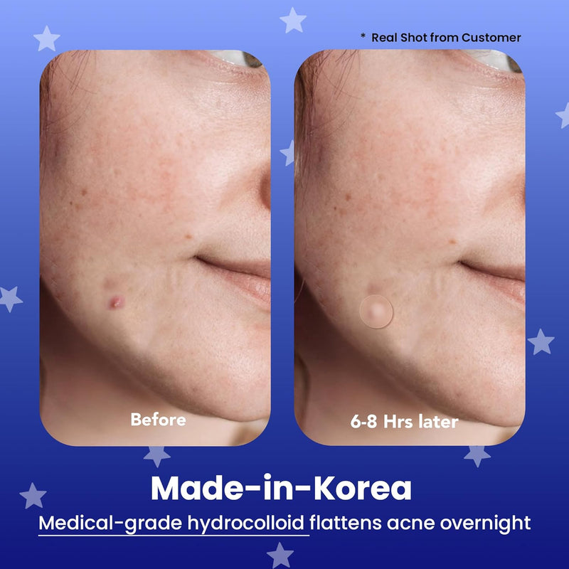 AVARELLE Spot Pimple Patches for Face and Good Night Acne Cover