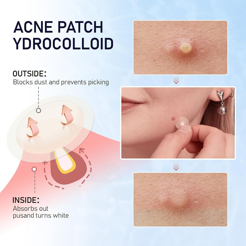 Pimple Patches for Face, 2 Sizes 192 Counts Acne Patches