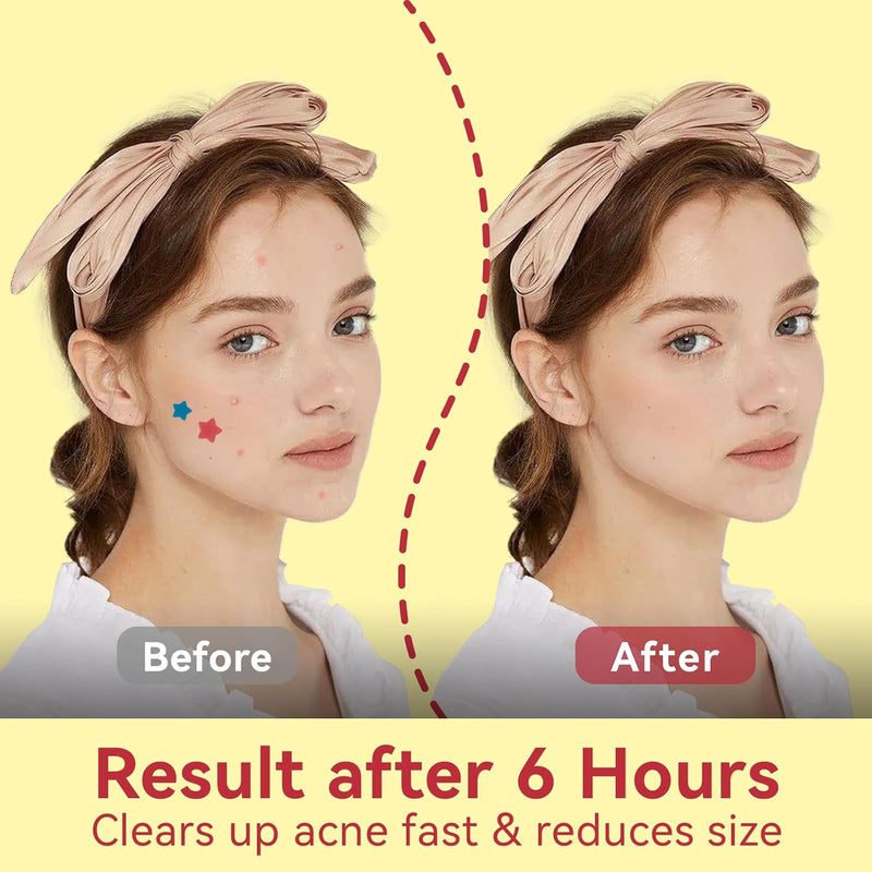 Star Pimple Patches for Face (66 patches)