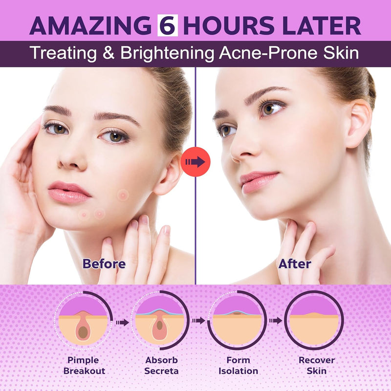 FSA HSA Acne Treatment | Anti-Bacterial Pimple Patches